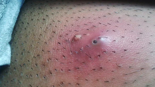 A Weight Off His Shoulder | Dr. Pimple Popper