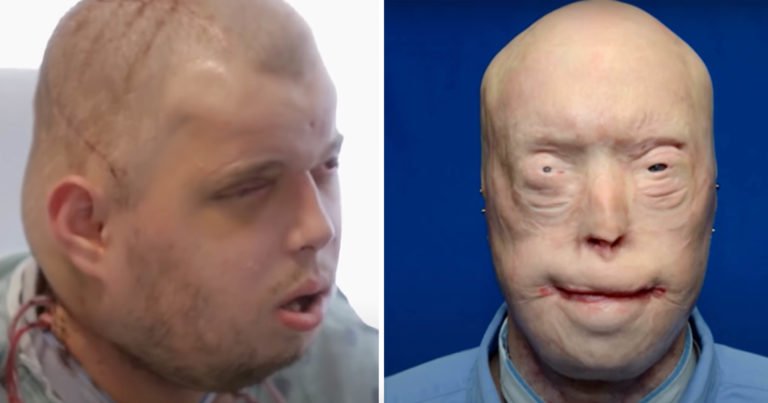 Firefighter suffers third-degree burns – this is him 11 years later