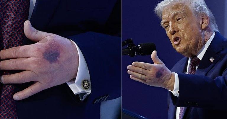 Trump explains the heavy bruise on his left hand came from ‘clipped it on the table’